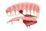 Removable partial denture