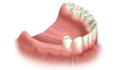 Multiple Teeth Replacement